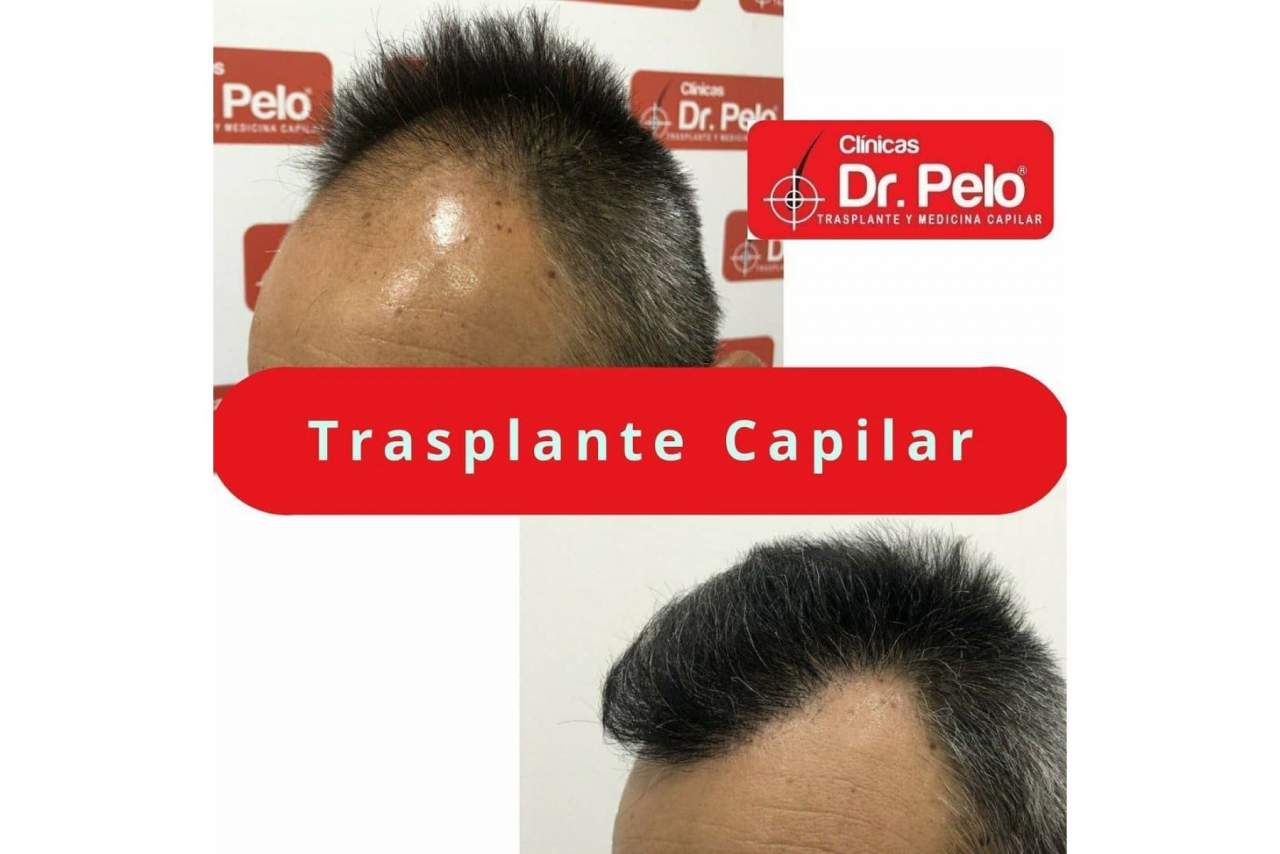 Las opiniones sobre el injerto capilar de las Clínicas Dr. Pelo en Sevilla
