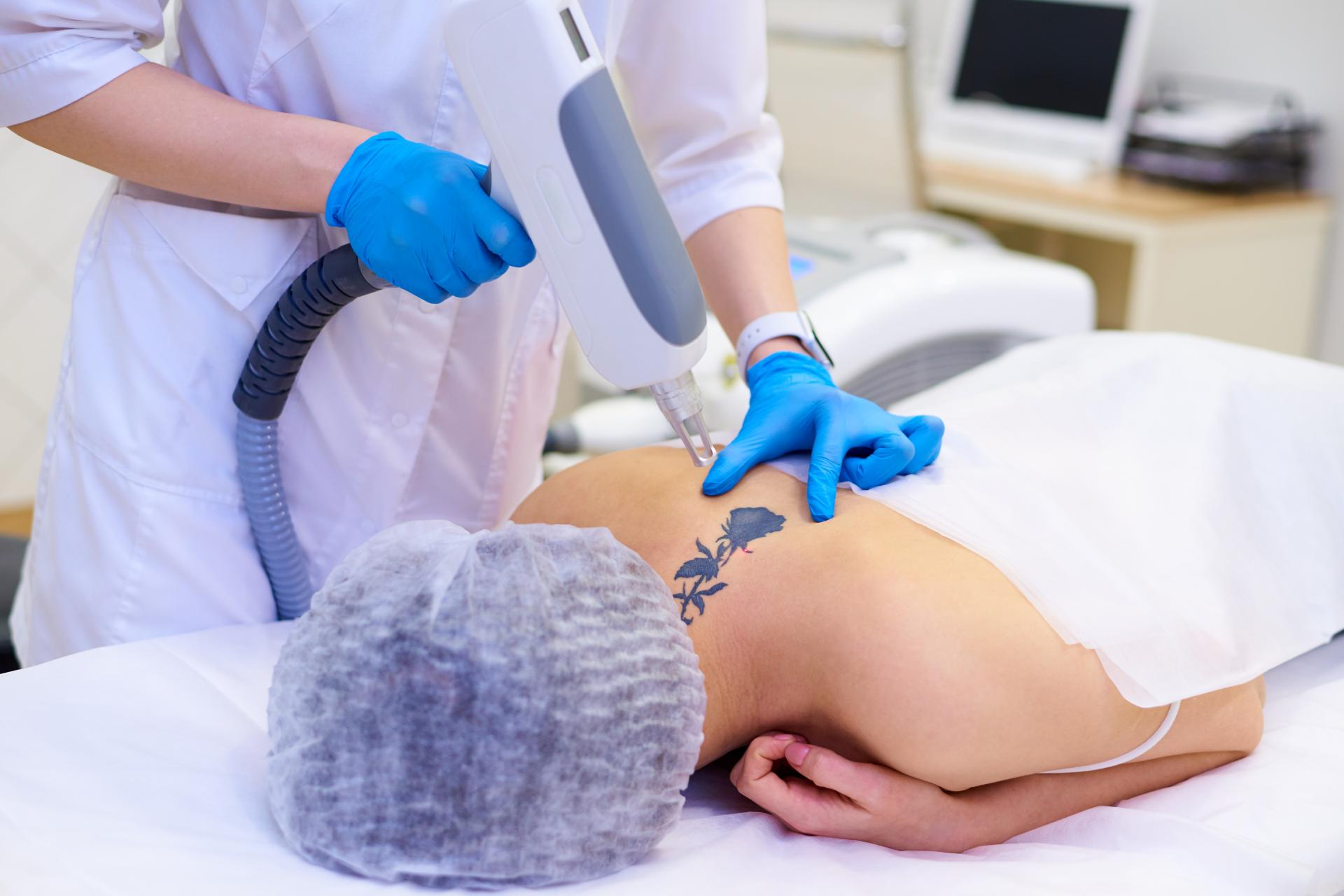 Bodyslim: Yag Láser para eliminar tatuajes