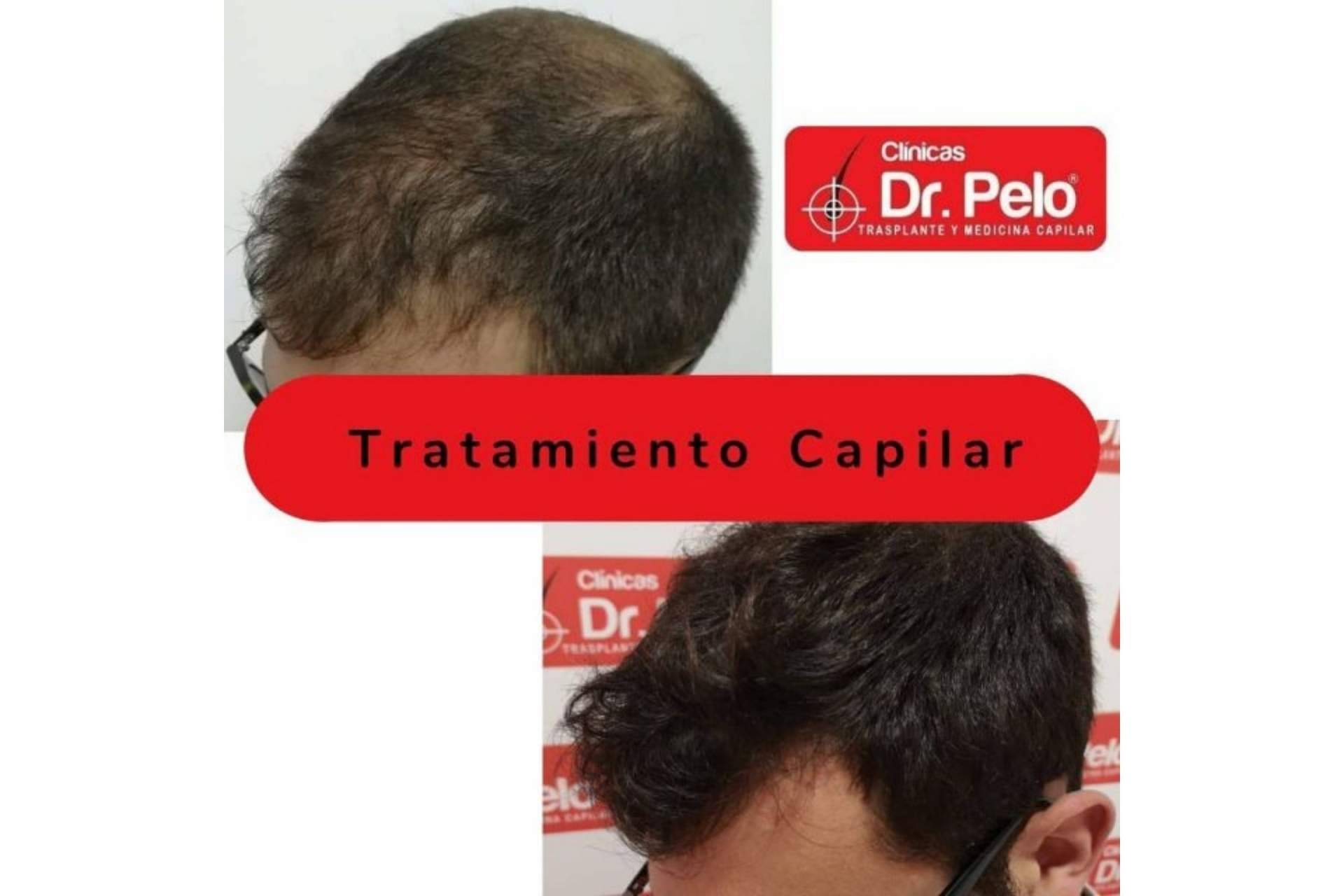 El tratamiento de injerto capilar en Sevilla gana popularidad gracias a las Clínicas Dr. Pelo