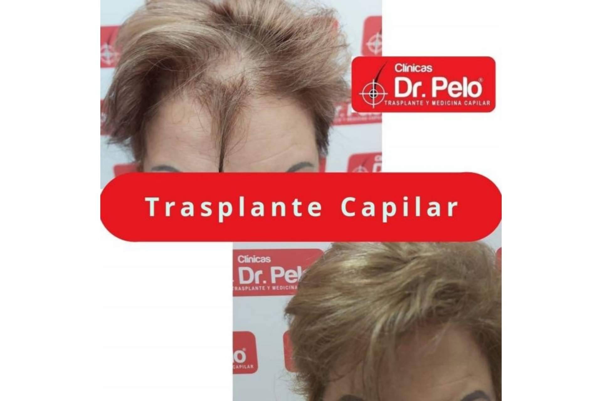 Frenar las entradas en el pelo gracias a las Clínicas Dr. Pelo