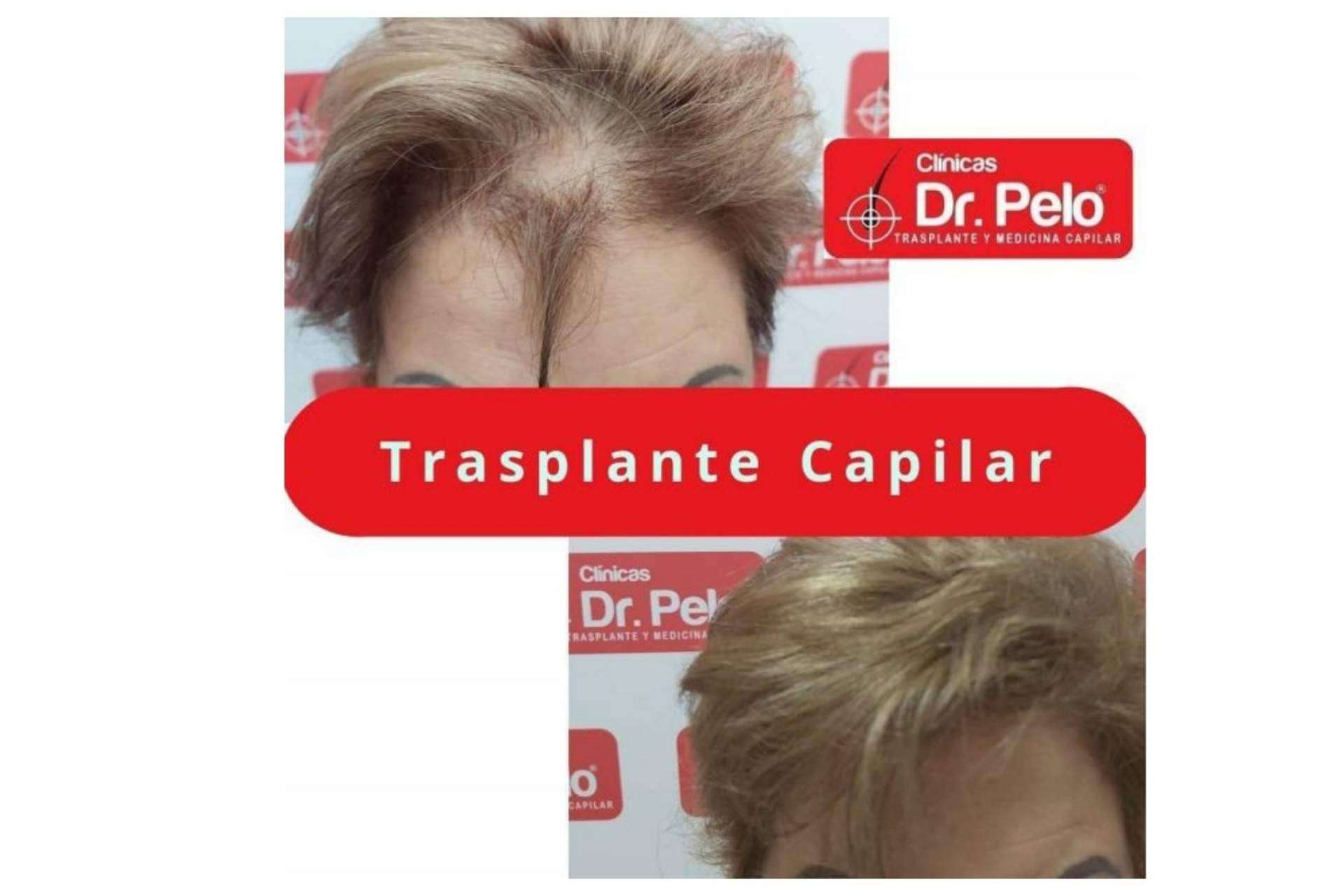 Clínica Dr.Pelo: ¿Cuál es la mejor clínica para realizarse un tratamiento de injerto capilar en Sevilla?