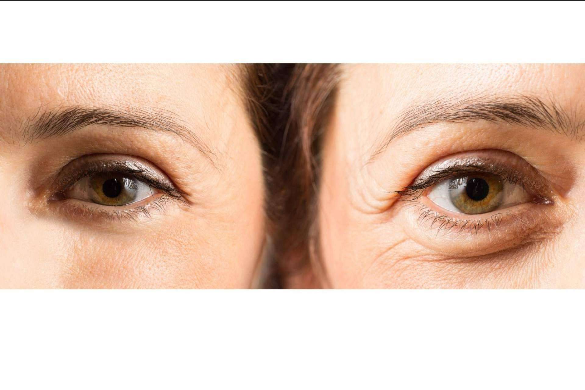 Ácido hialurónico para combatir las ojeras: Unidad de medicina estética FEMME de Santiago de Compostela con la Dra. Alfonsina Uriburu