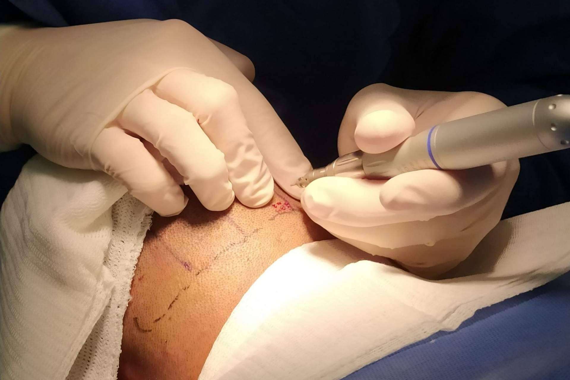 Clínica Tarrazo: microinjerto capilar en la clínica estética de Alcobendas
