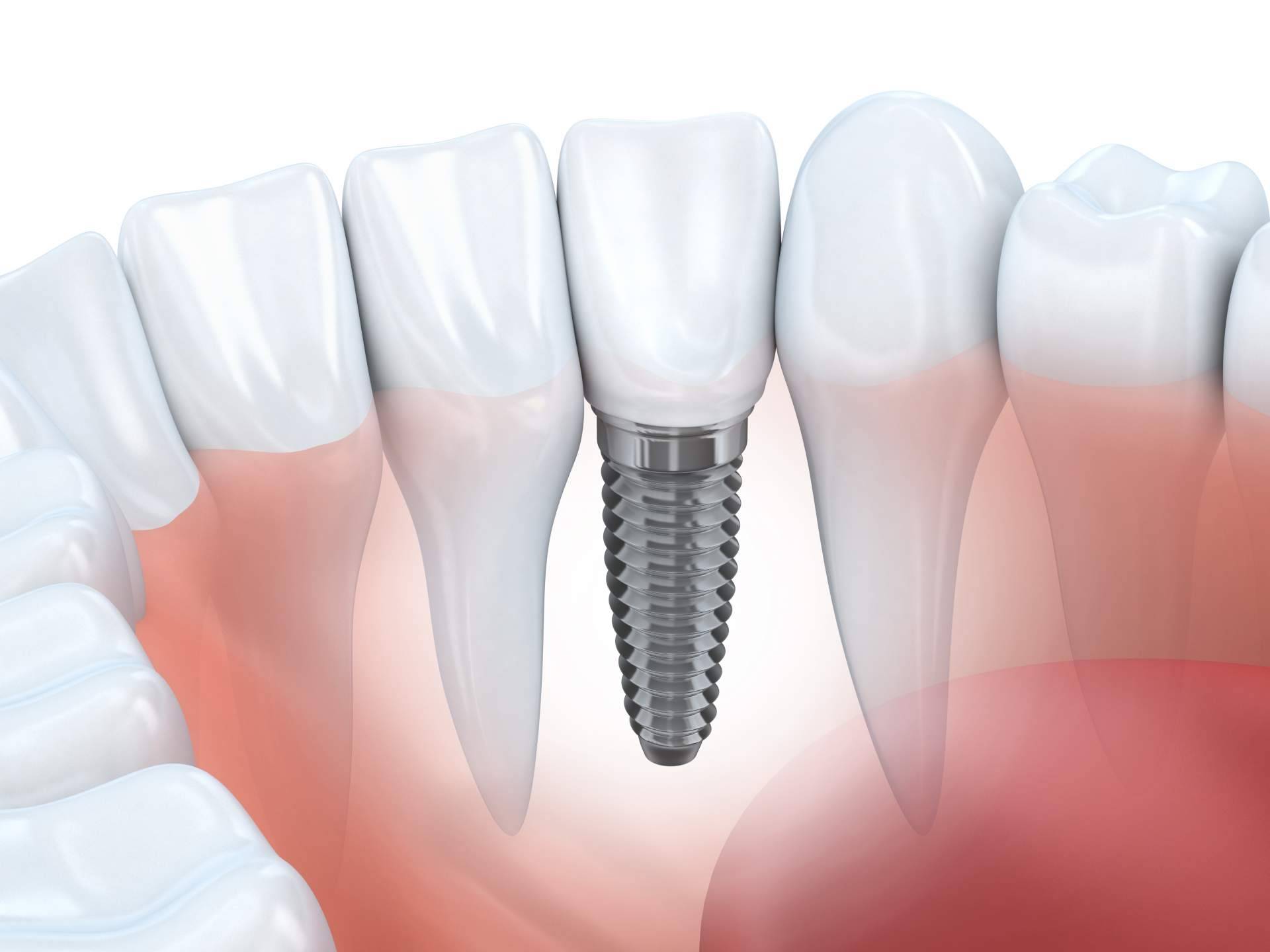 El procedimiento de implante dental de titanio en Sevilla que ofrece Clínica Dental Helident