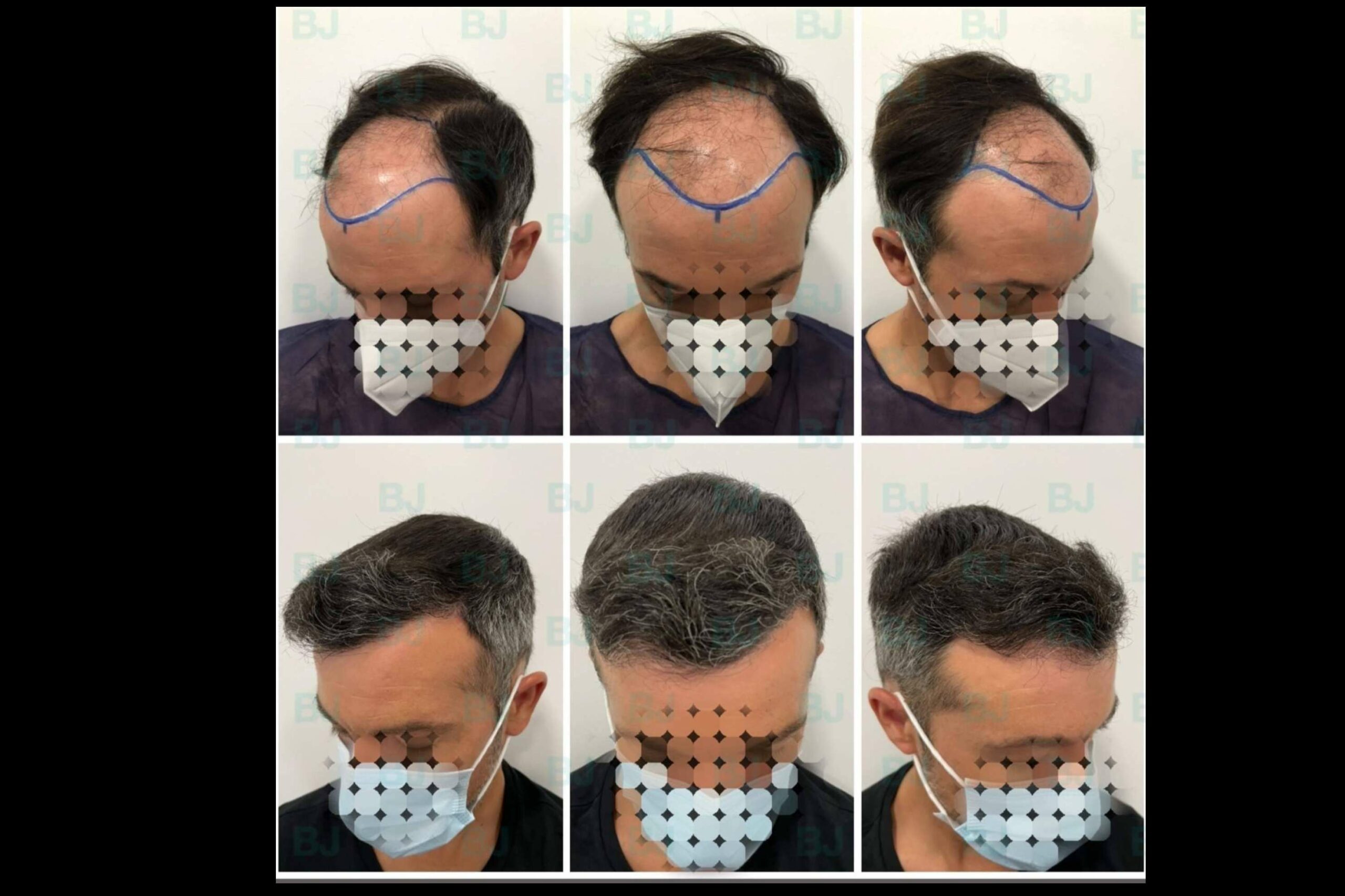Dr. Bruno Jacobovski, el especialista en injerto capilar en Barcelona que cuenta con más de 500 intervenciones exitosas