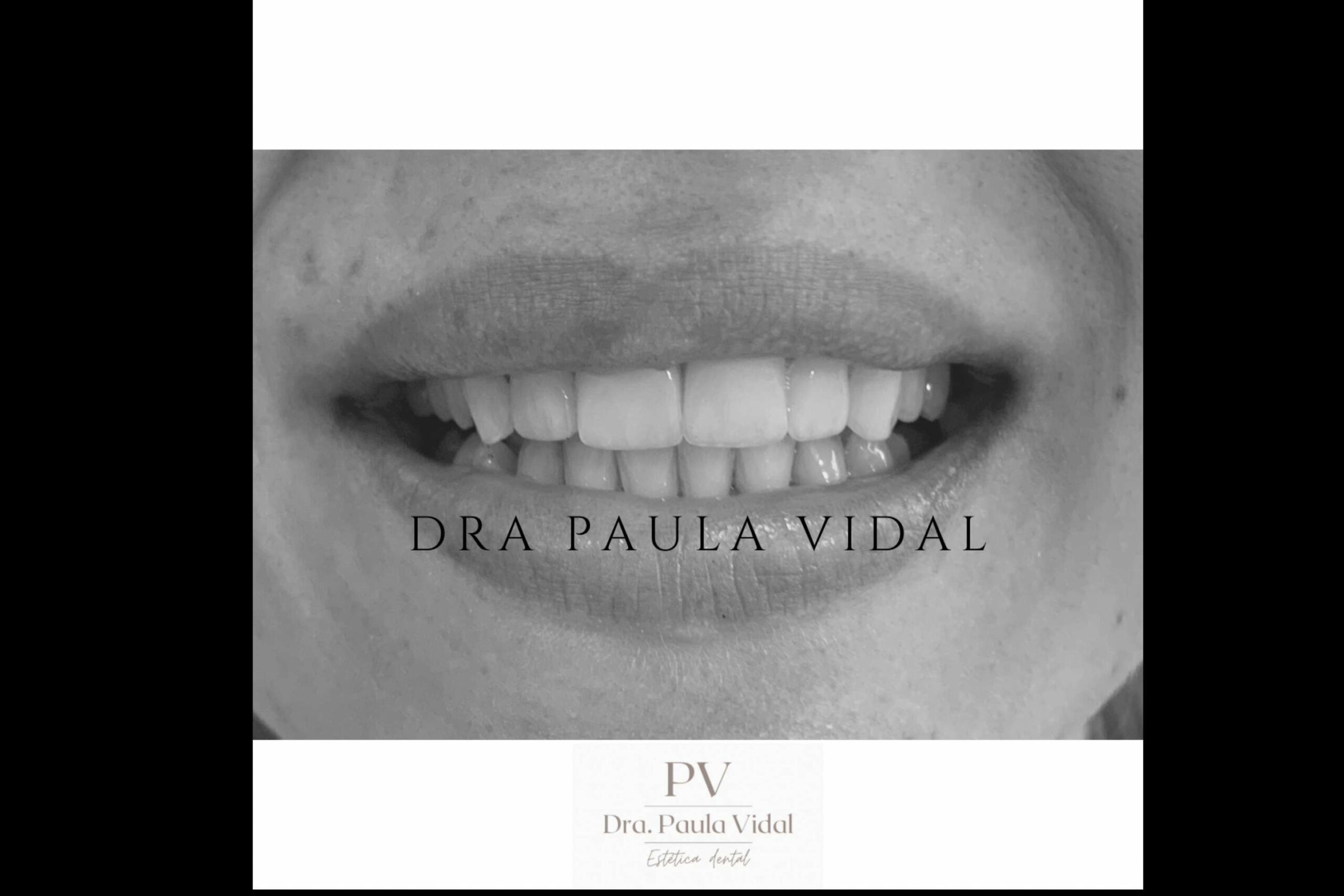 La aplicación de carillas dentales en la Clínica Paula Vidal