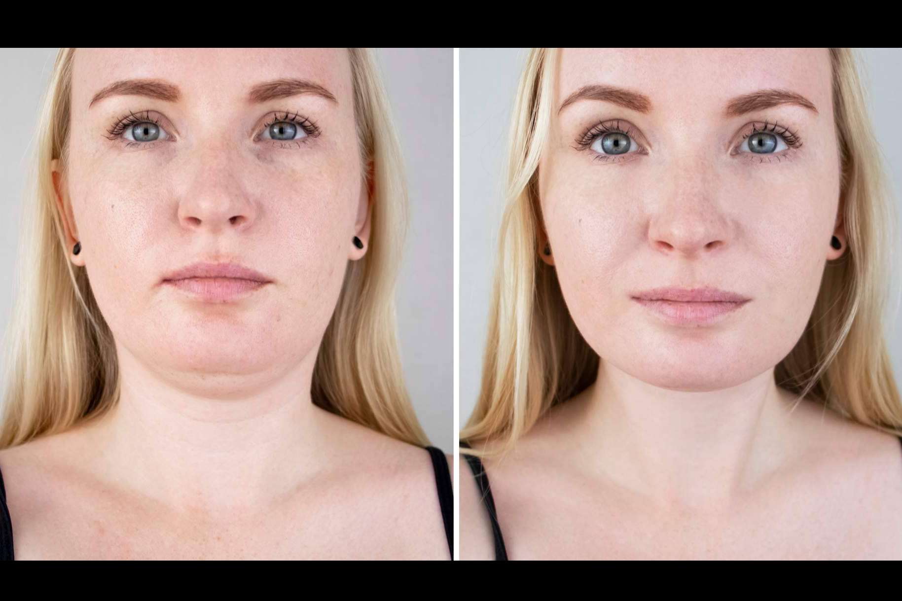 Clínica Femme permite eliminar la papada y la flacidez facial con el lifting láser