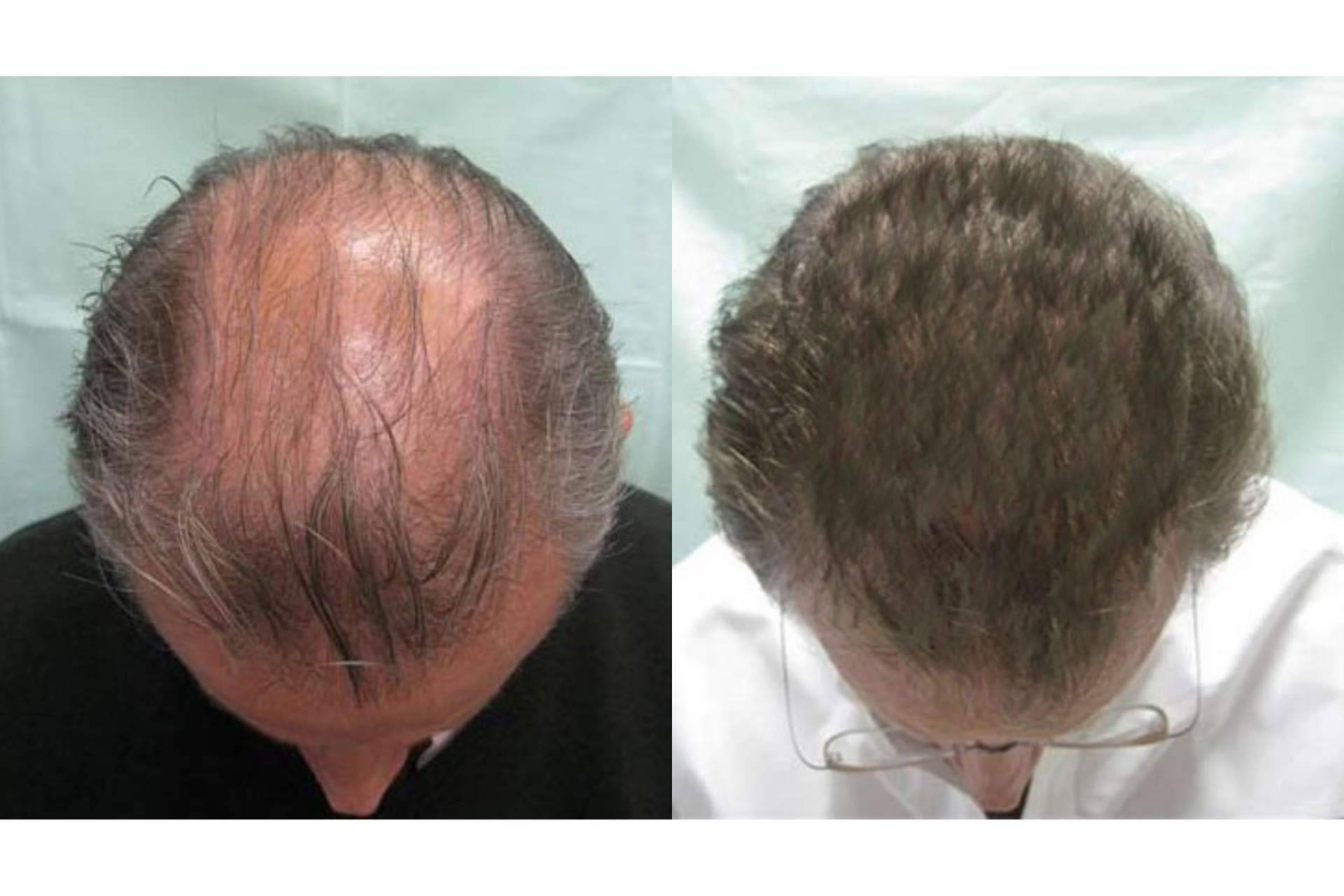Tratamientos efectivos para alopecia androgenética, de la mano de Innovación Capilar
