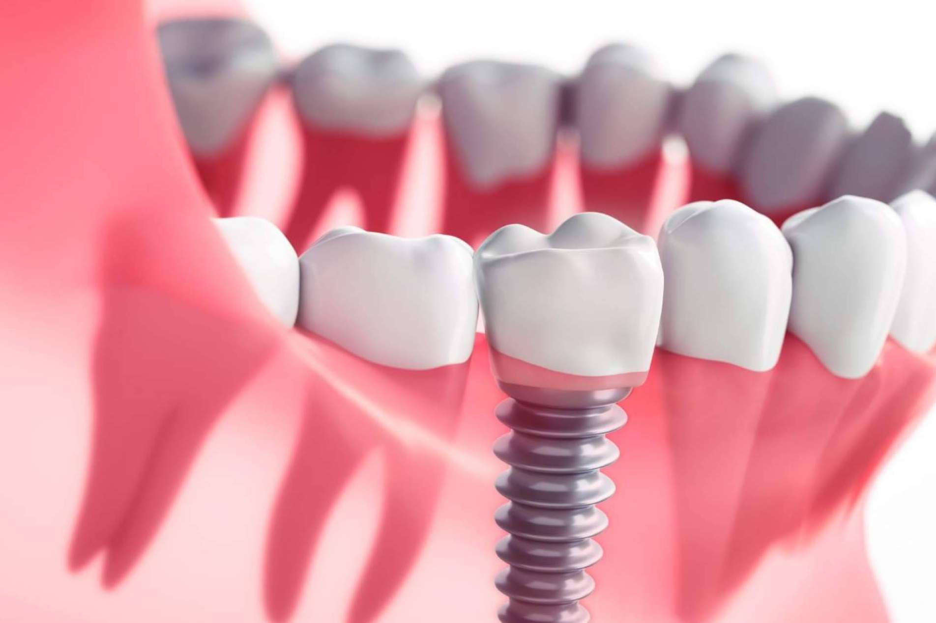 Clínica Dental Crespí & Gandía encuentra la técnica de rehabilitación oral perfecta para cada caso