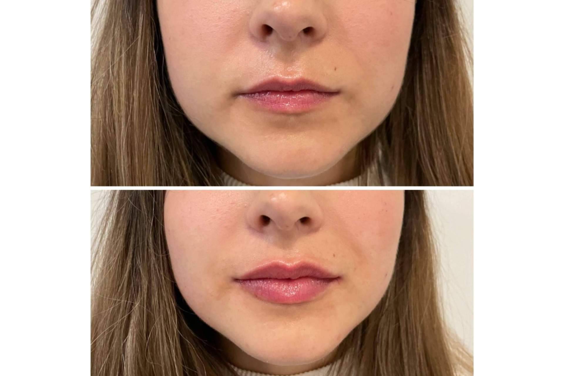 ¿Se puede lograr un aumento de labios en Madrid con resultados naturales?, por la Dra. Cecilia Arthur