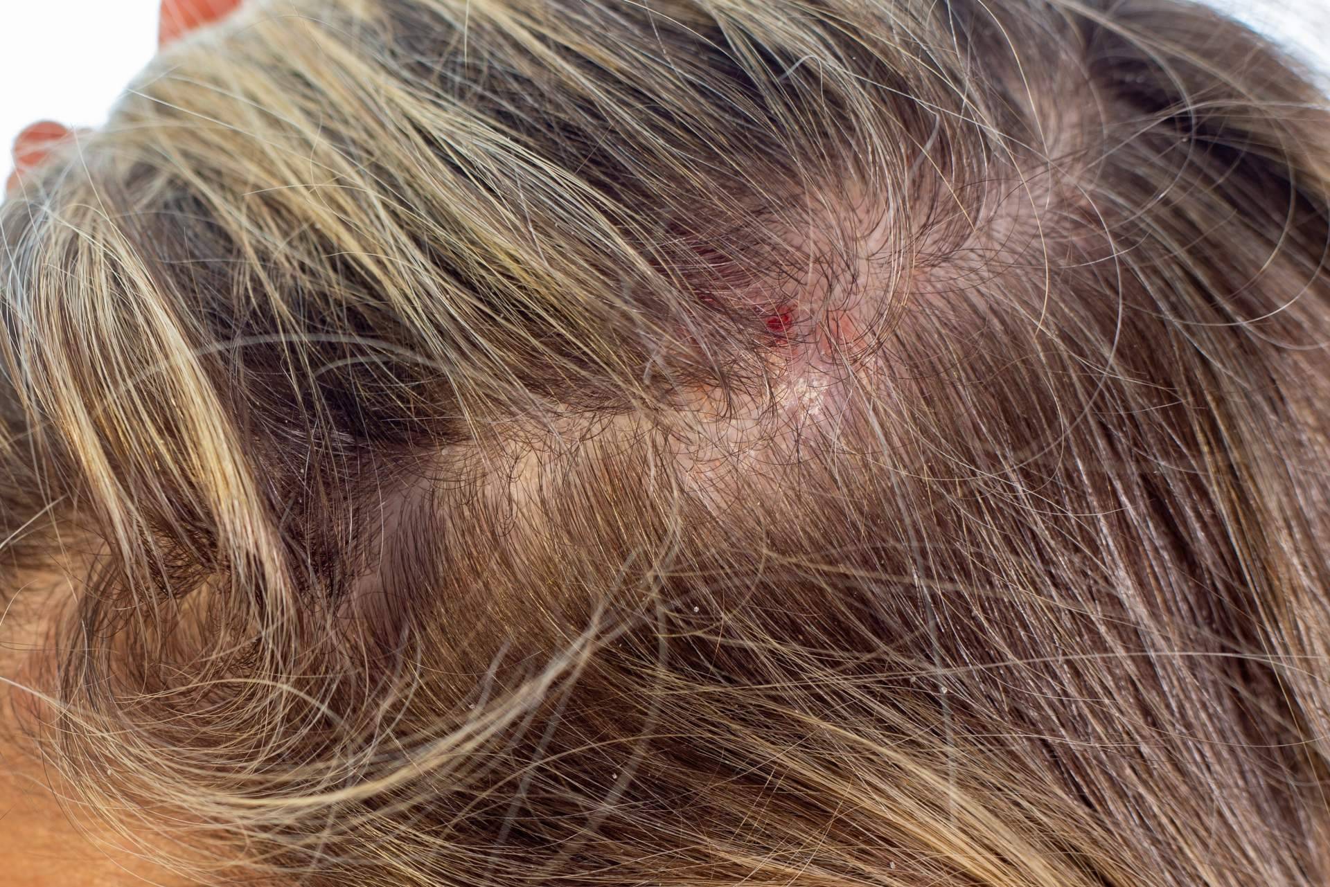 Una afección que puede provocar alopecia si no se trata es la dermatitis seborreica