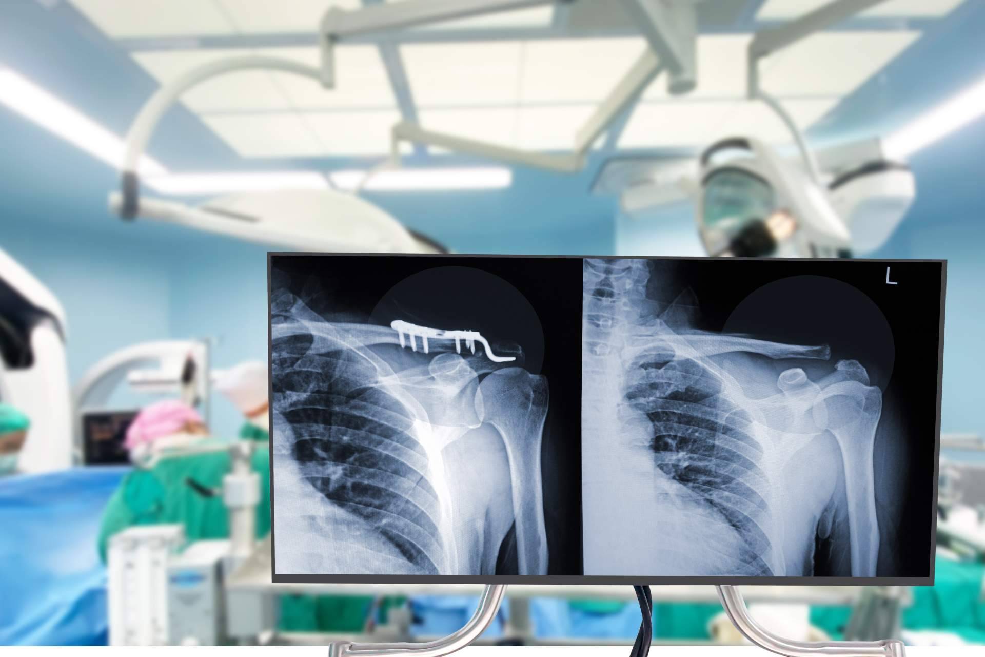 ¿Cuáles son los deportes en los que se produce un mayor número de fracturas de clavícula?, por el Dr. Miguel Romero