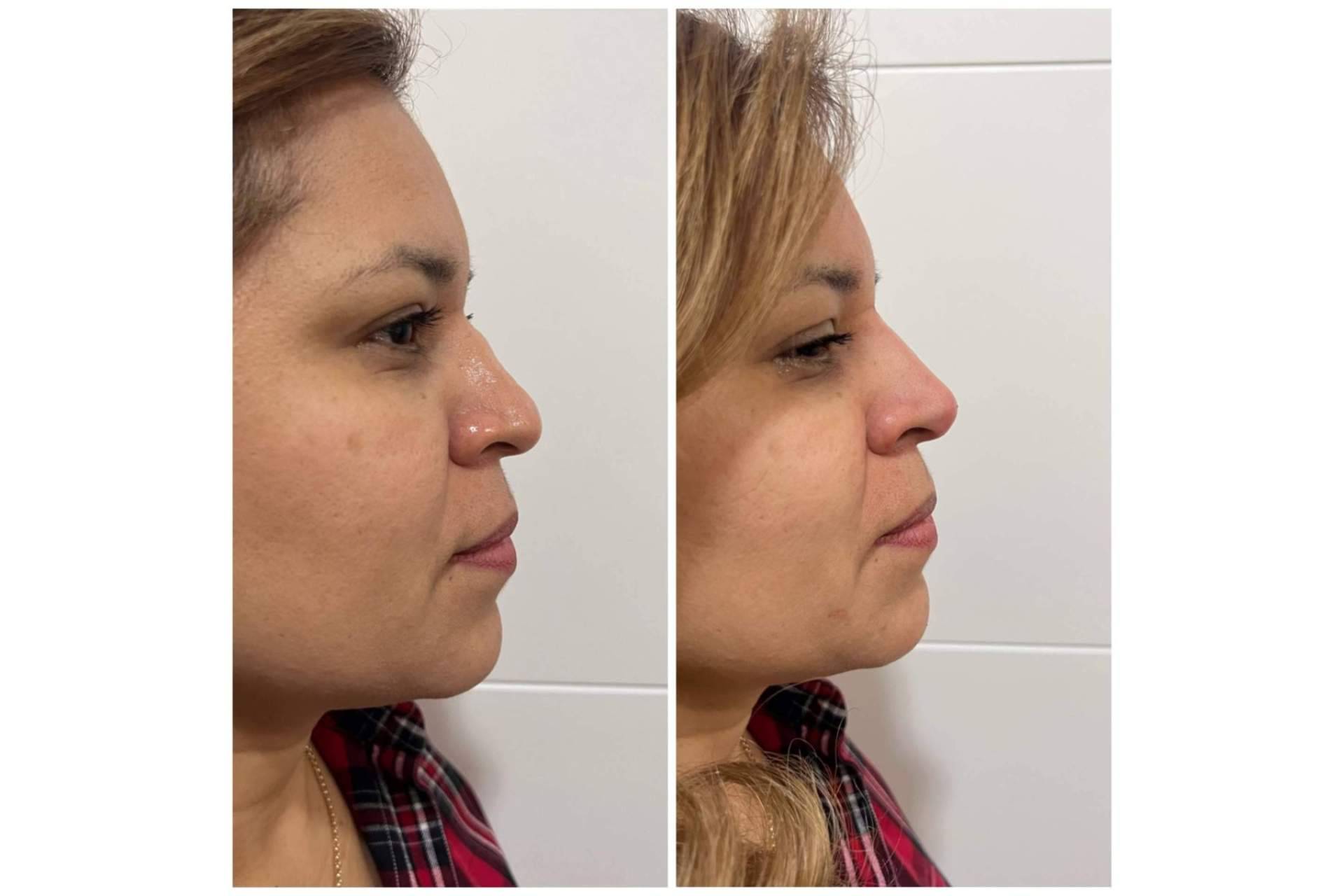 Cecilia Arthur lleva a cabo la rinomodelación sin cirugía de forma exitosa