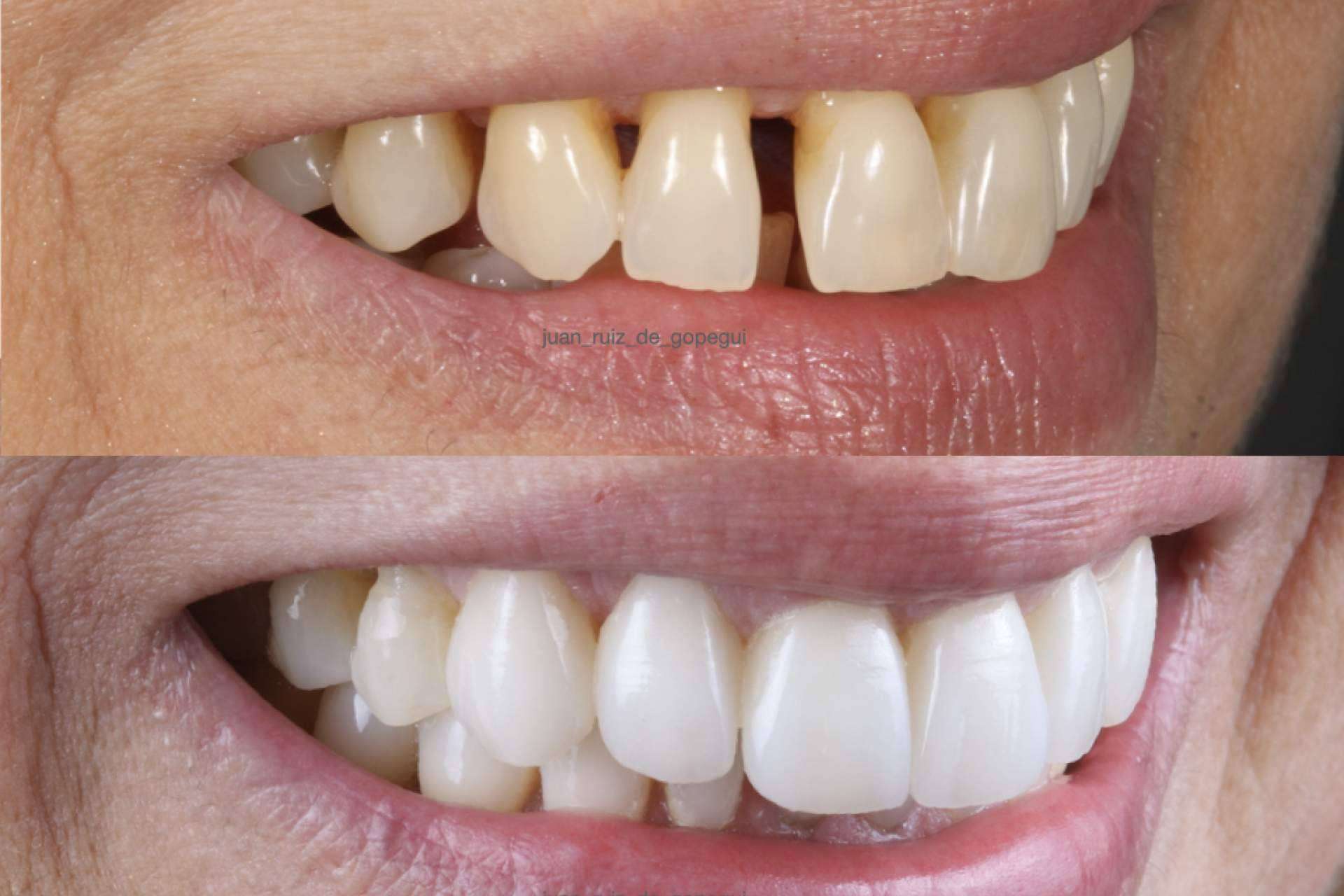 ¿Por qué elegir las carillas de porcelana para mejorar la sonrisa?