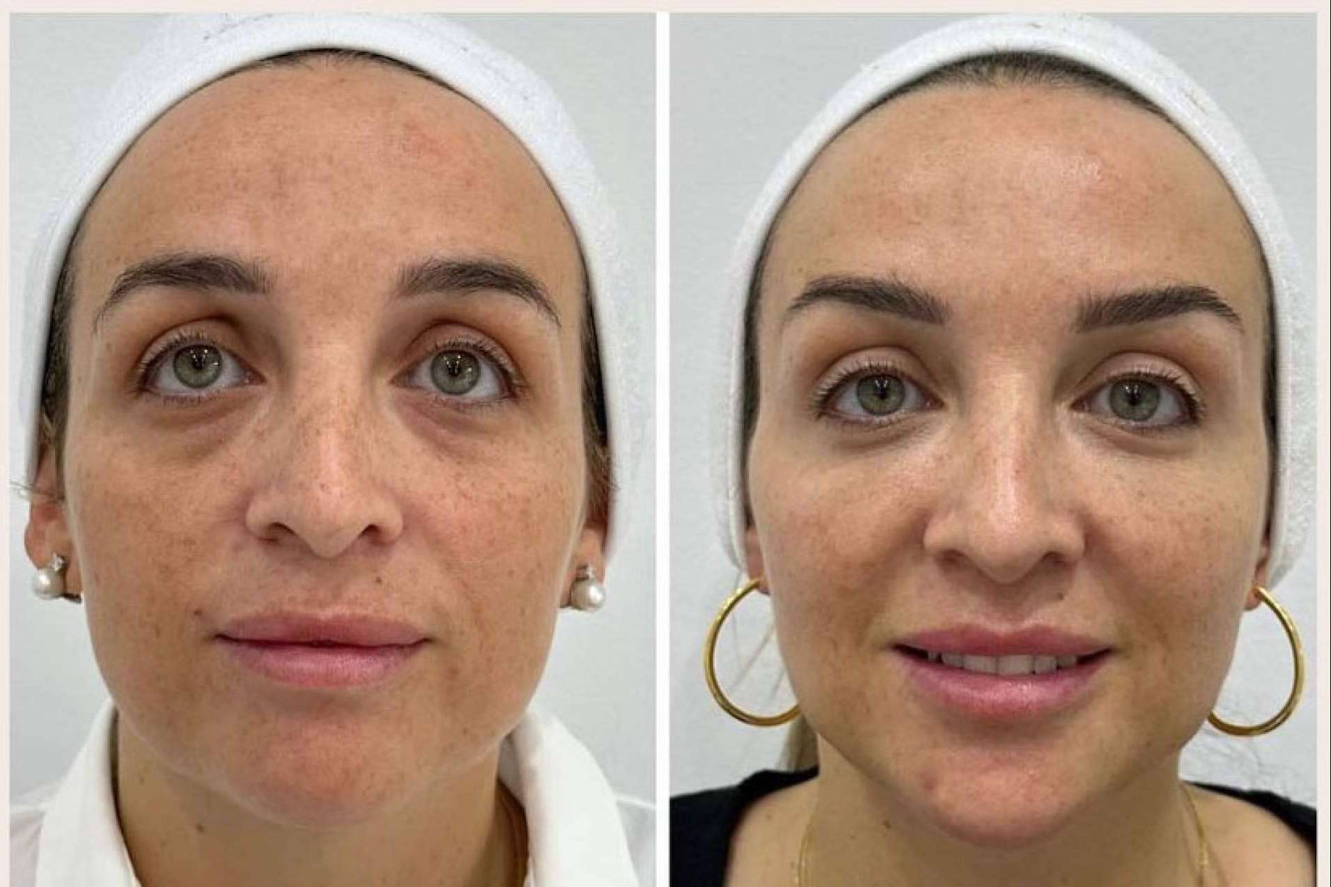 ¿Cómo combatir la flacidez facial?, por Clínica VISO