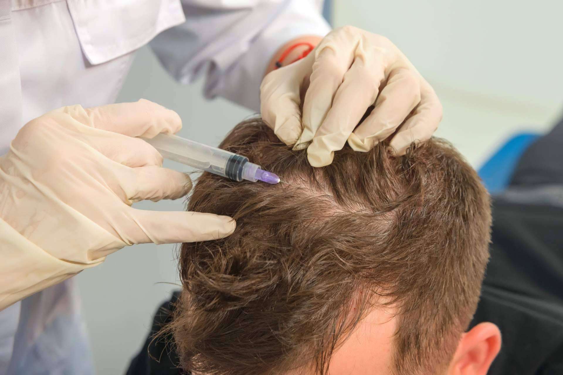 Conocer las ventajas de realizarse un tratamiento de mesoterapia capilar de IMD para recuperar las condiciones óptimas del cabello