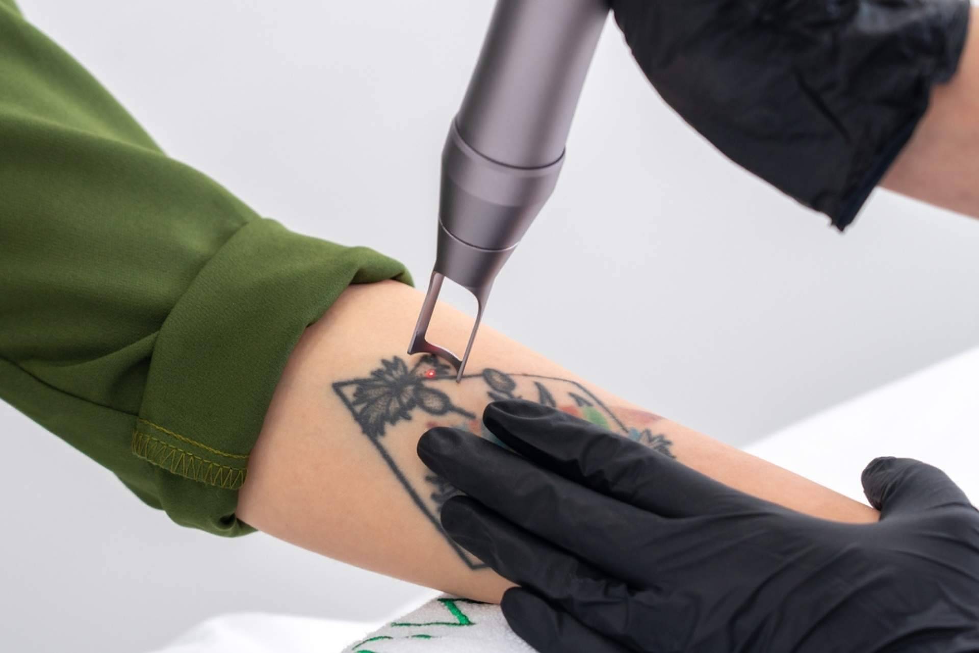 Ink Láser. Tecnología avanzada para borrar tatuajes en Alicante