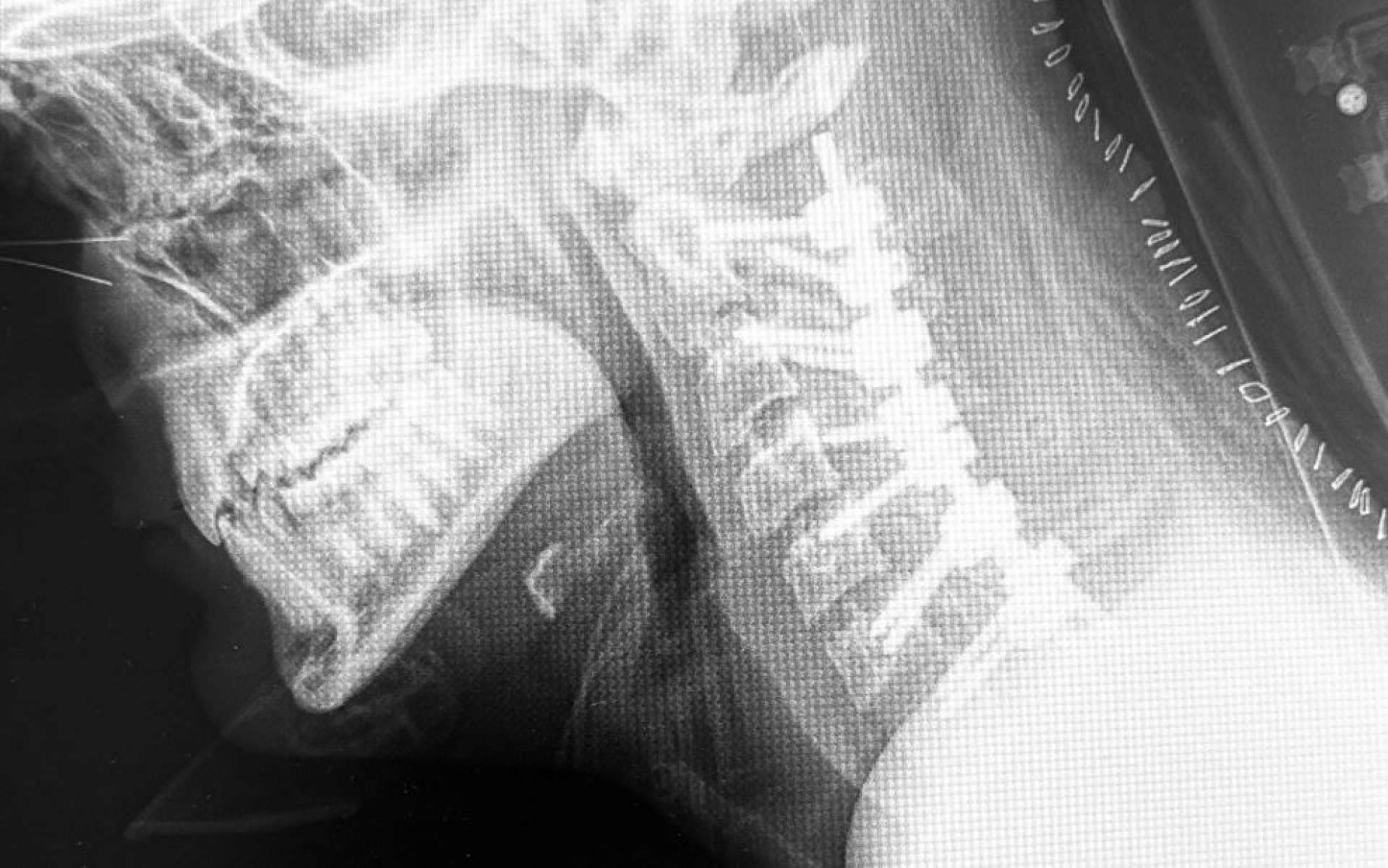 Cifosis post-laminectomía cervical