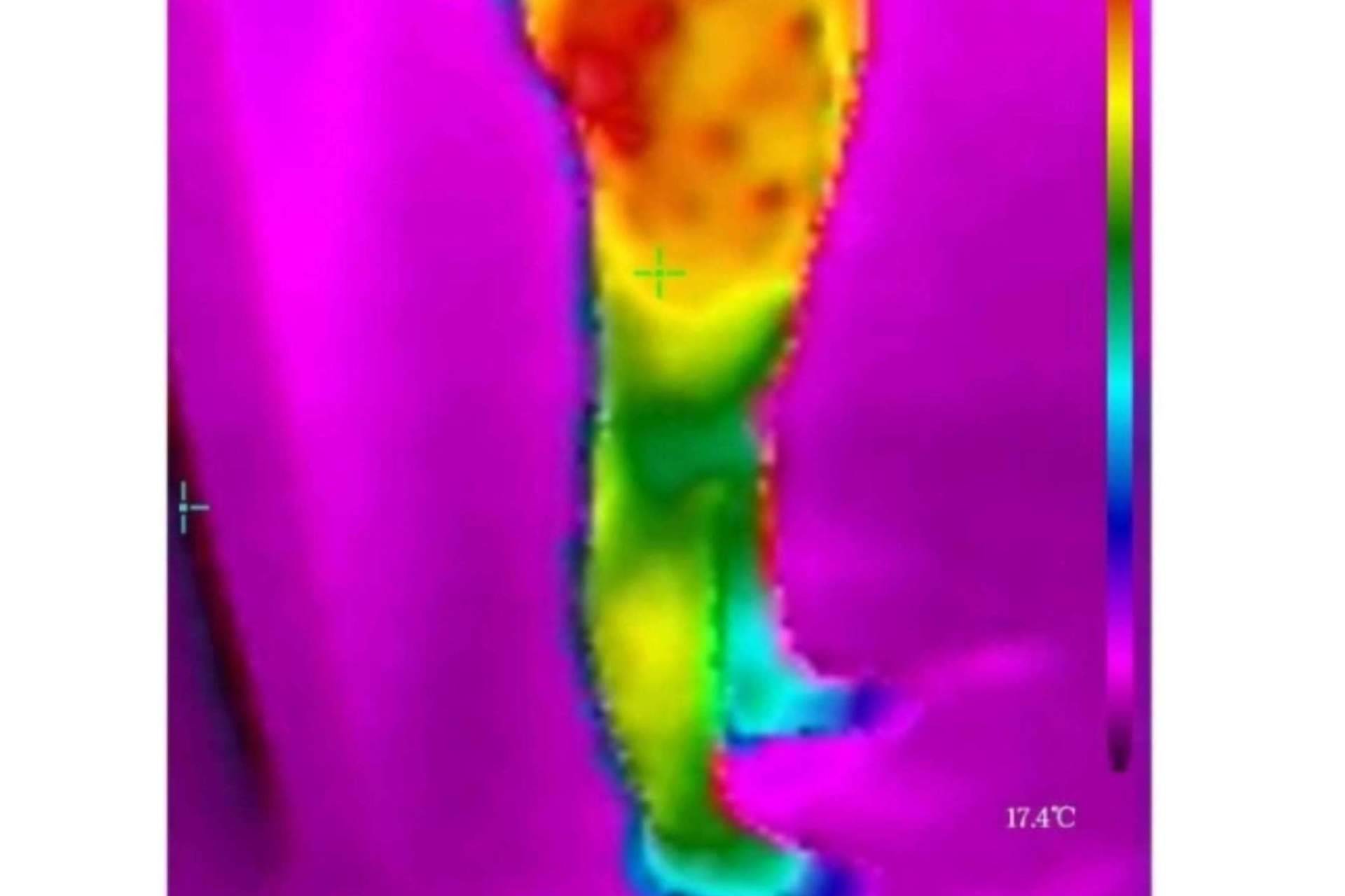 Es posible saber cuál es el tipo de celulitis con la cámara termográfica