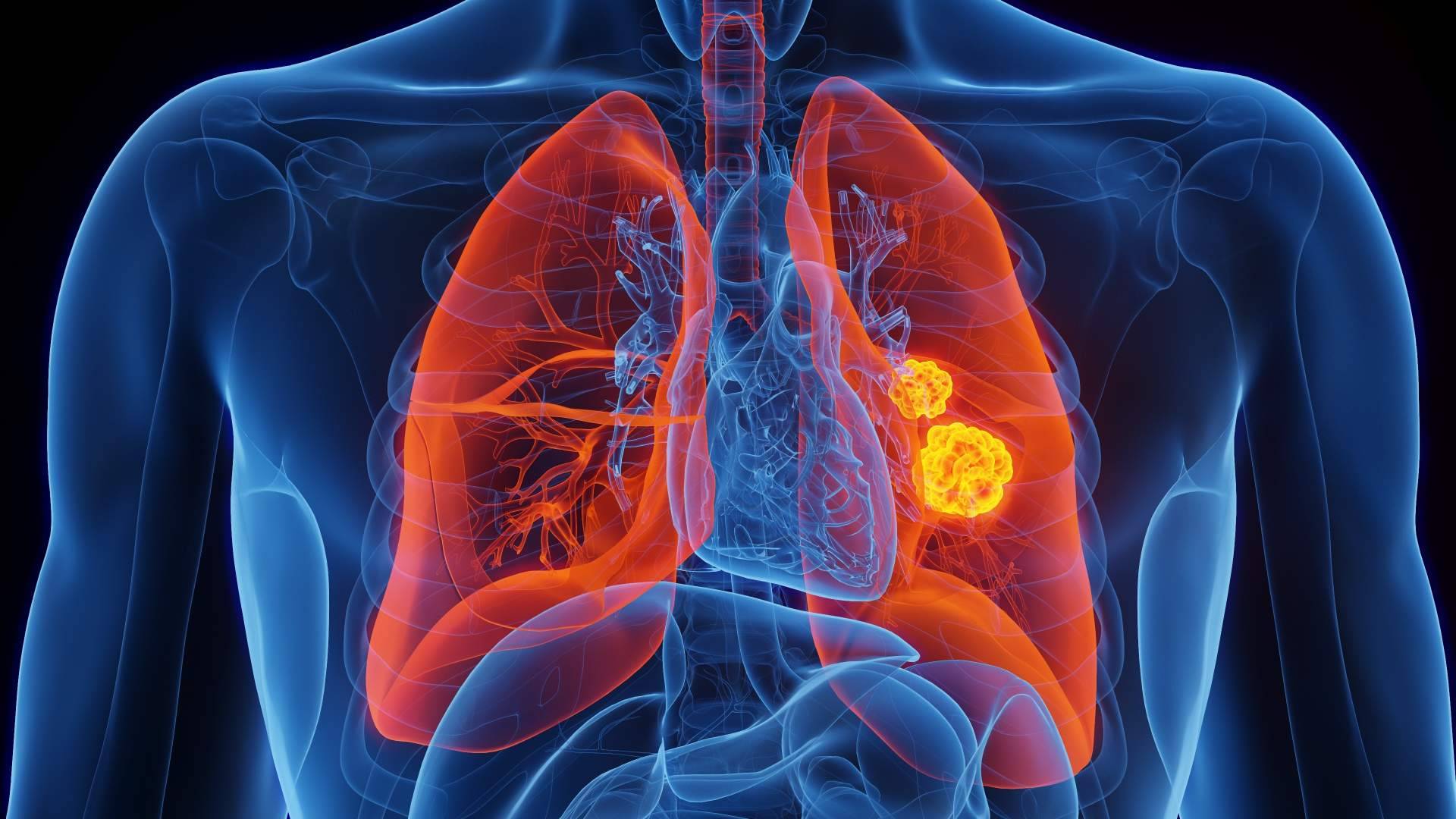Oncothermia (Nanothermia), el tratamiento de cáncer de pulmón