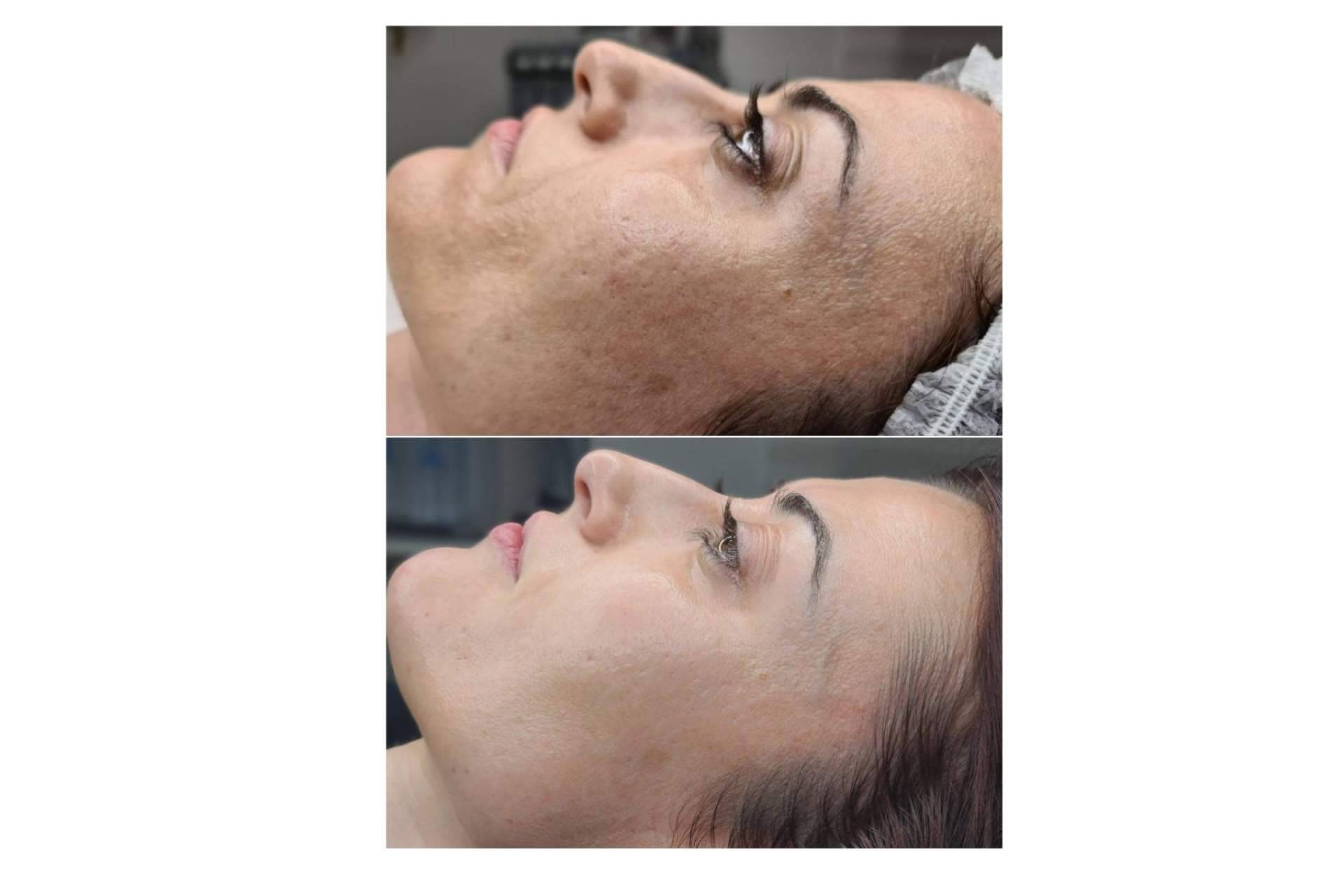 Clinica Marta Solà y la renovación celular con biomicroneedling, la técnica basada en espículas de esponja