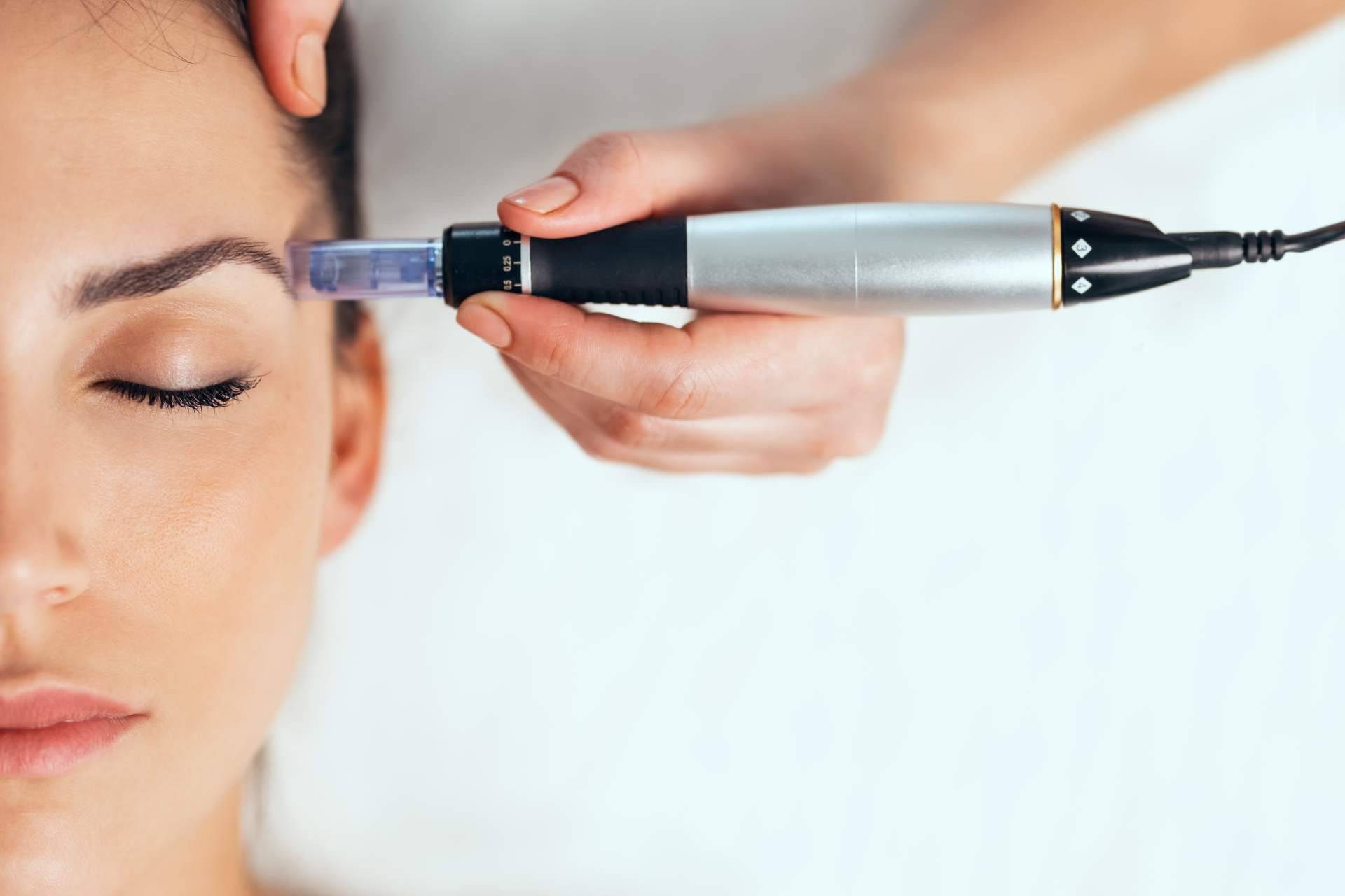 Tratar pequeñas cicatrices y mejorar el aspecto de la piel con dermapen en ojeras y en cicatrices de G&G Beauty