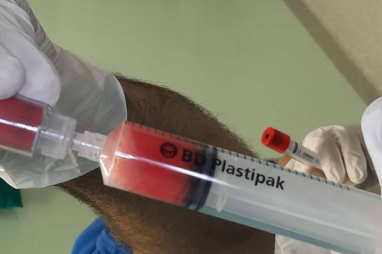 Tratar la artrosis de rodilla de manera eficaz sin cirugía a través de las infiltraciones de plasma rico en plaquetas y células madre