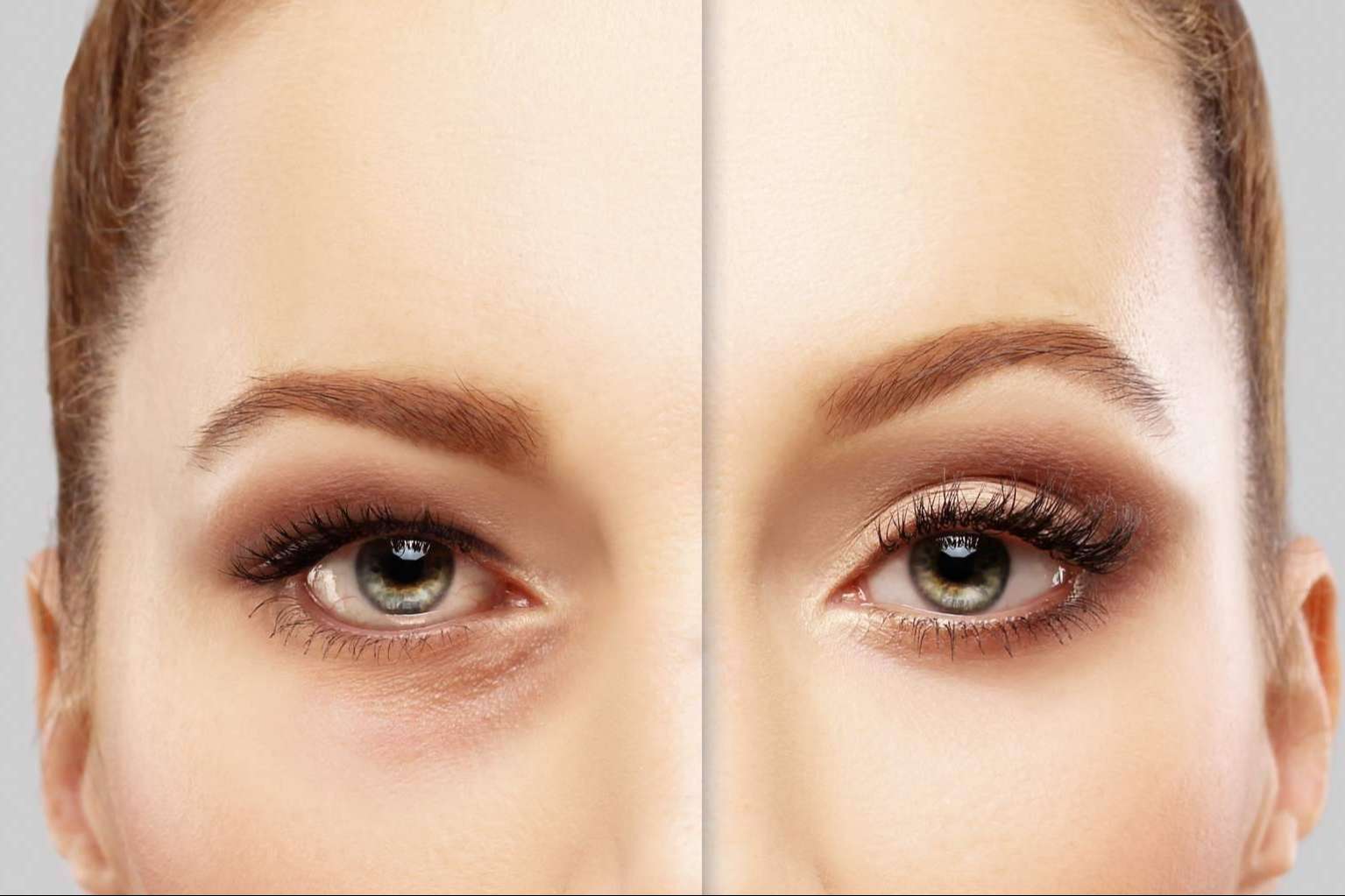 Tratar las ojeras con ácido hialurónico, de la mano de Centro Estética El Pilar