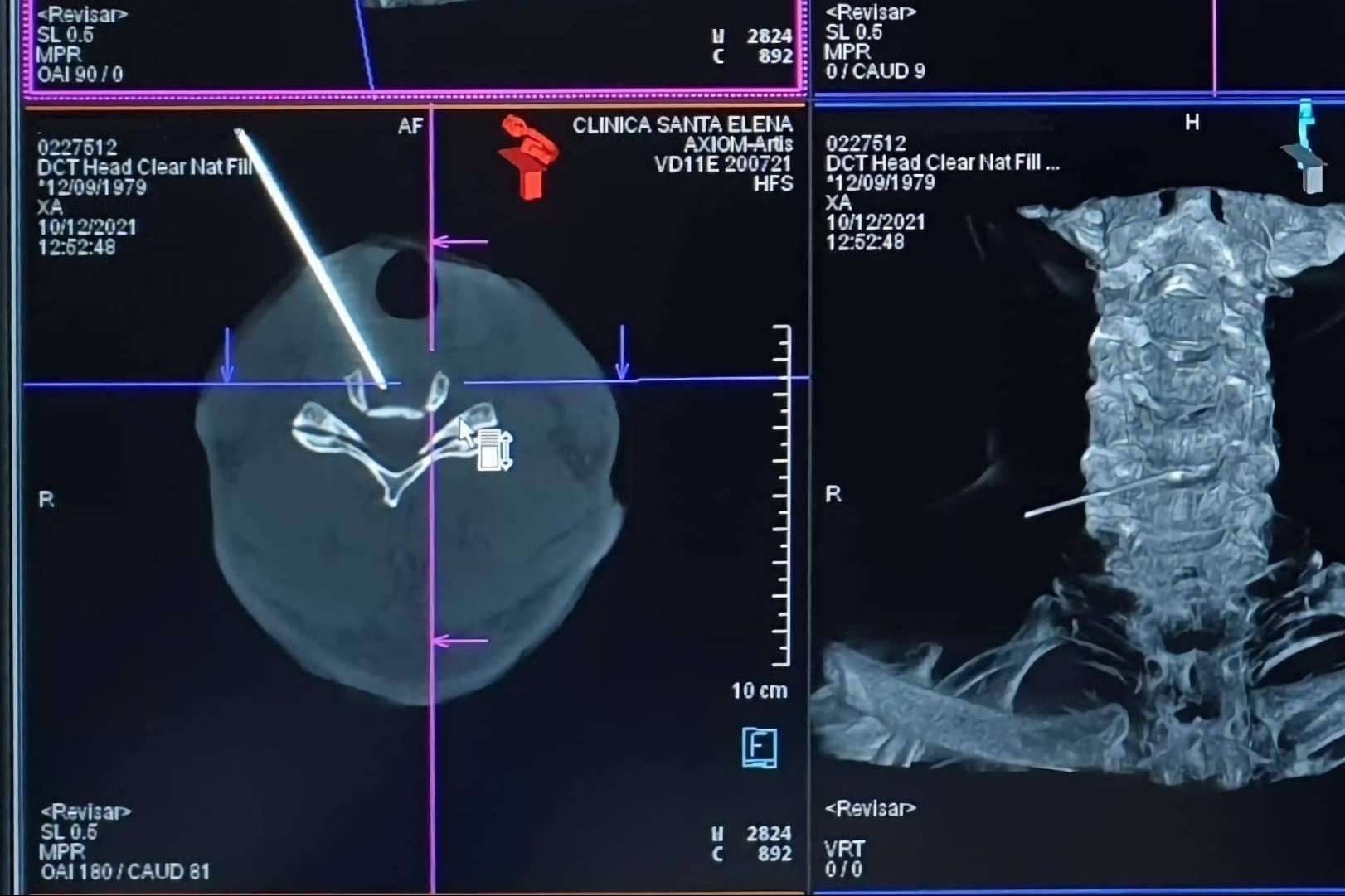 Al 82% los pacientes con hernia discal les funciona el tratamiento láser, en una sola sesión