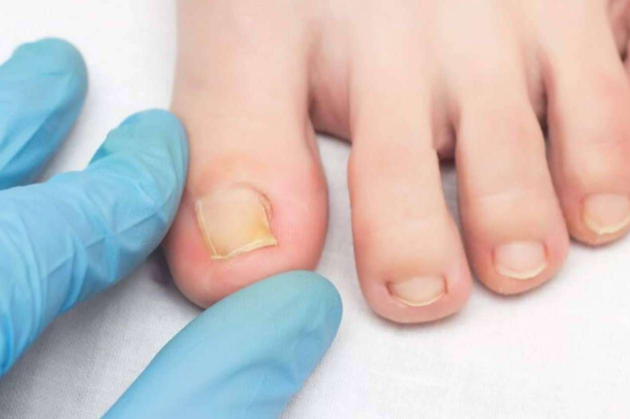 ¿Cómo prevenir las infecciones por hongos en verano?