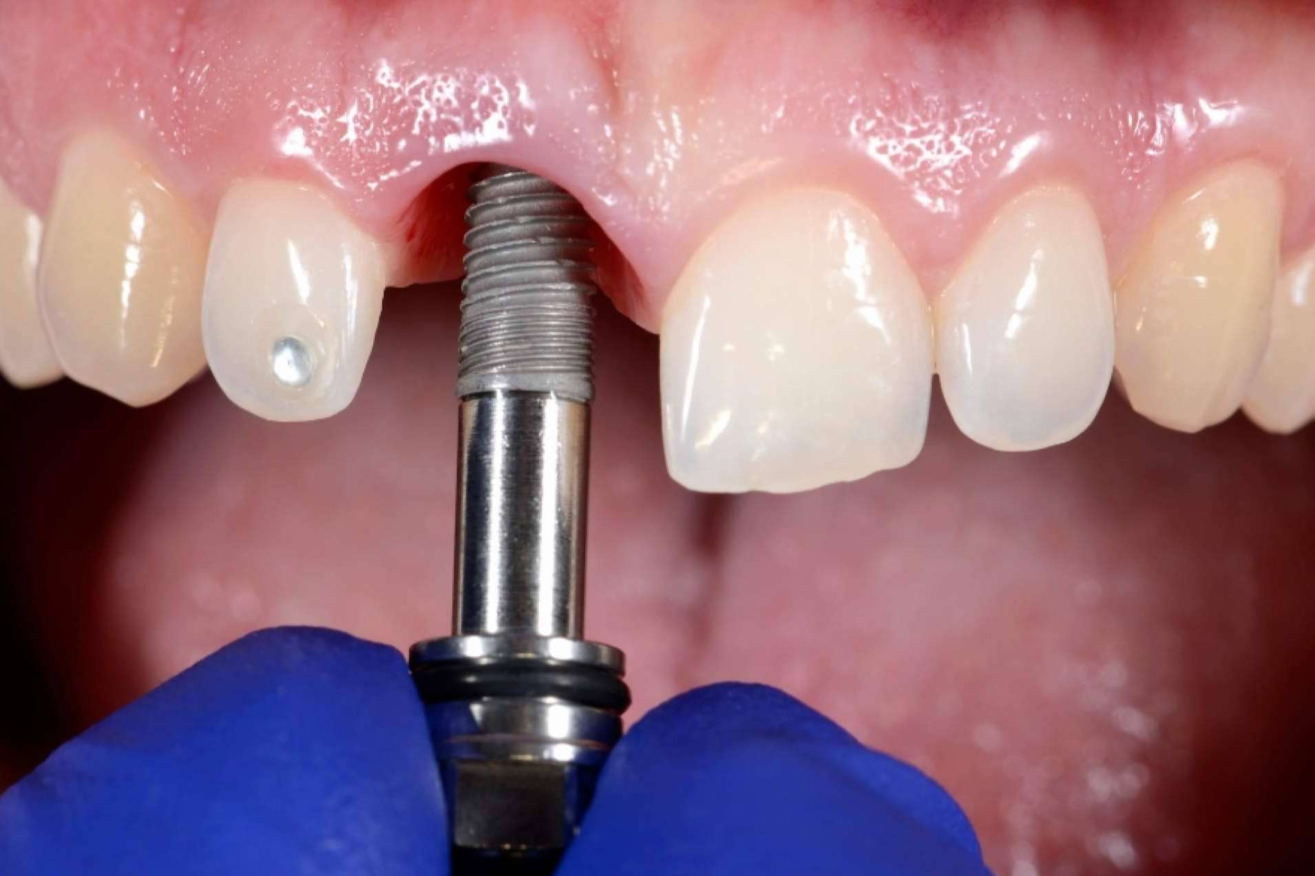 Los riesgos ocultos de las ofertas en cirugías dentales, por Clínicas Nobel