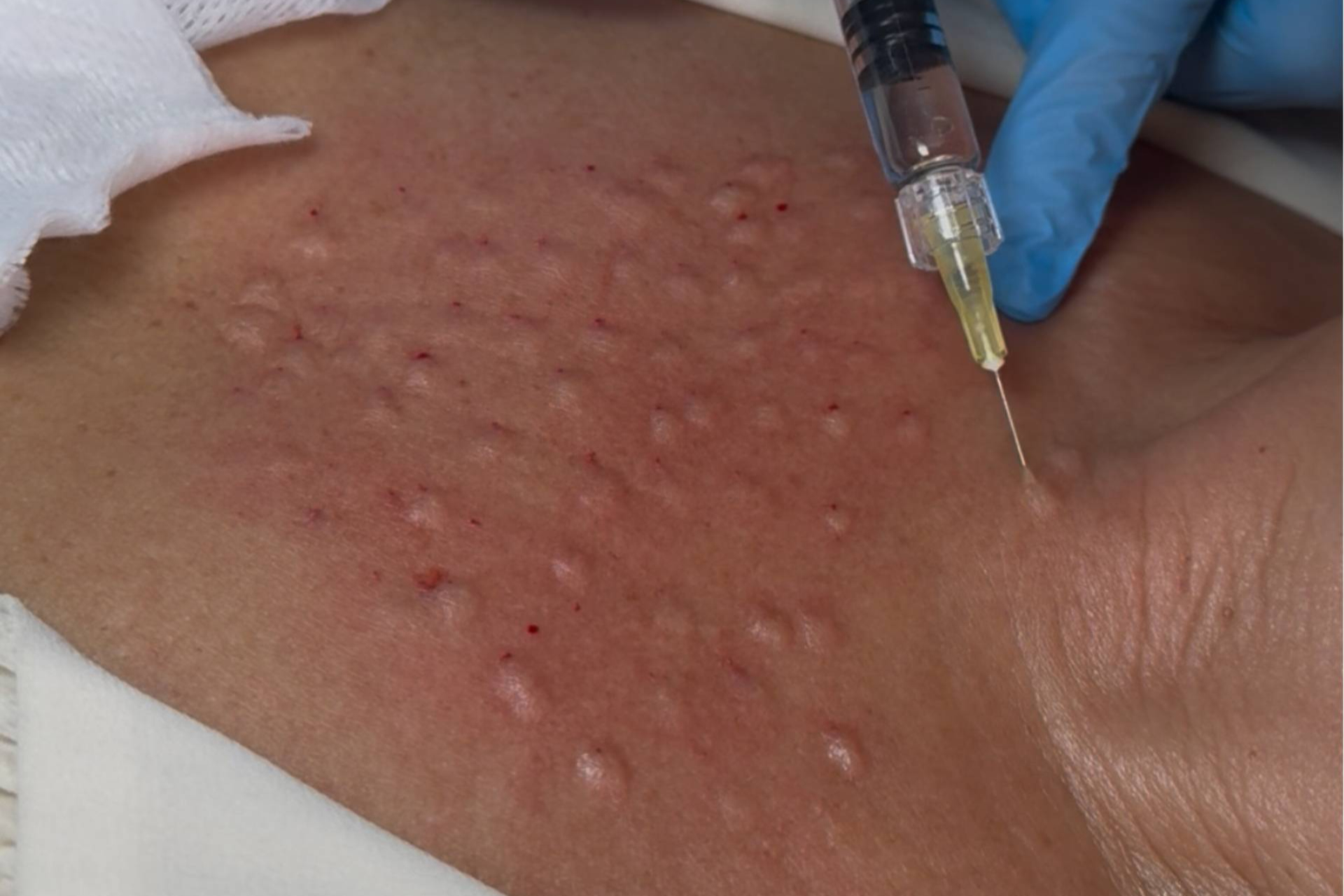 Así actúan los polinucleótidos; el tratamiento con ADN de salmón que marca tendencia global