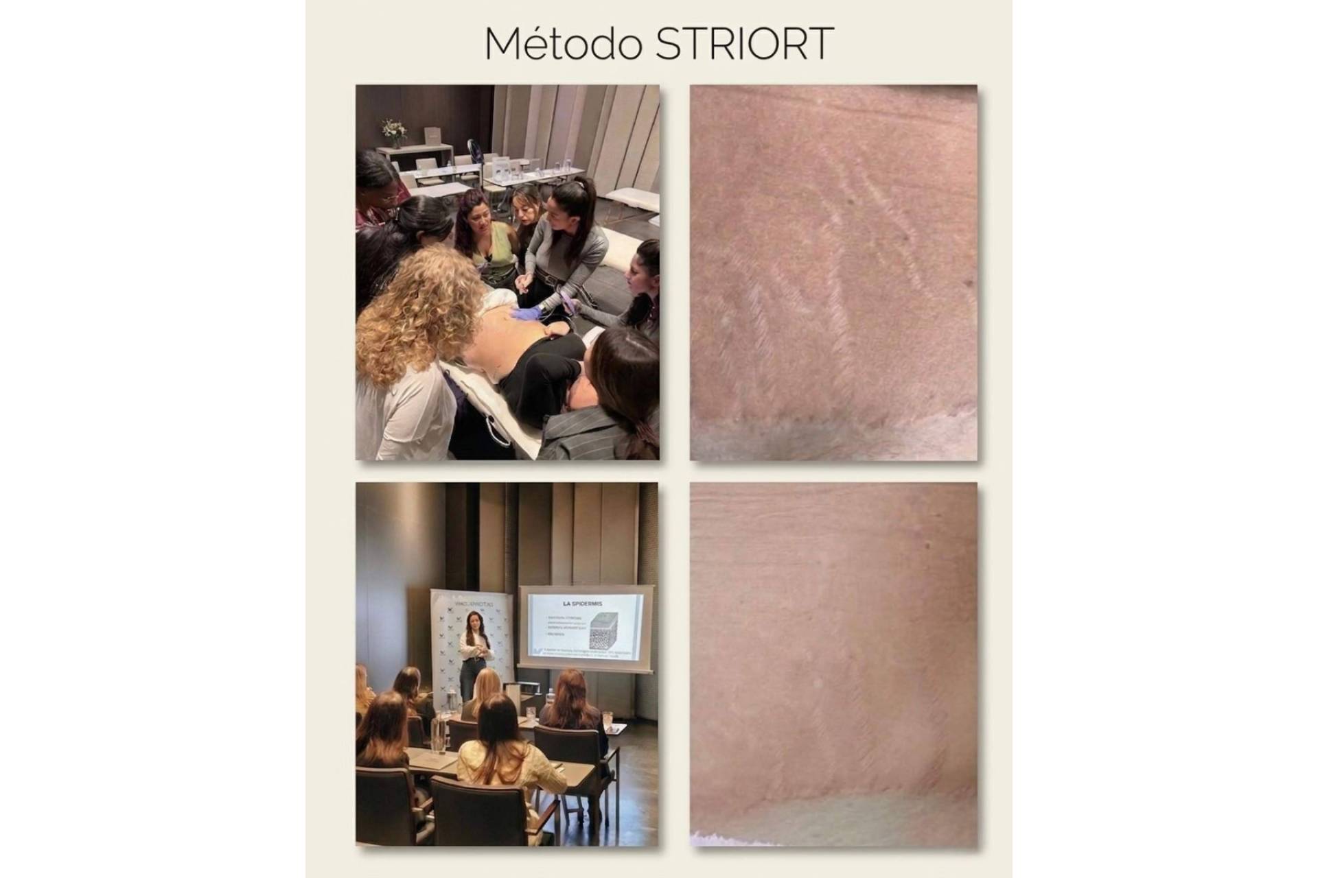 Un método internacional para estrías llega a España; STRIORT abre su formación oficial para profesionales