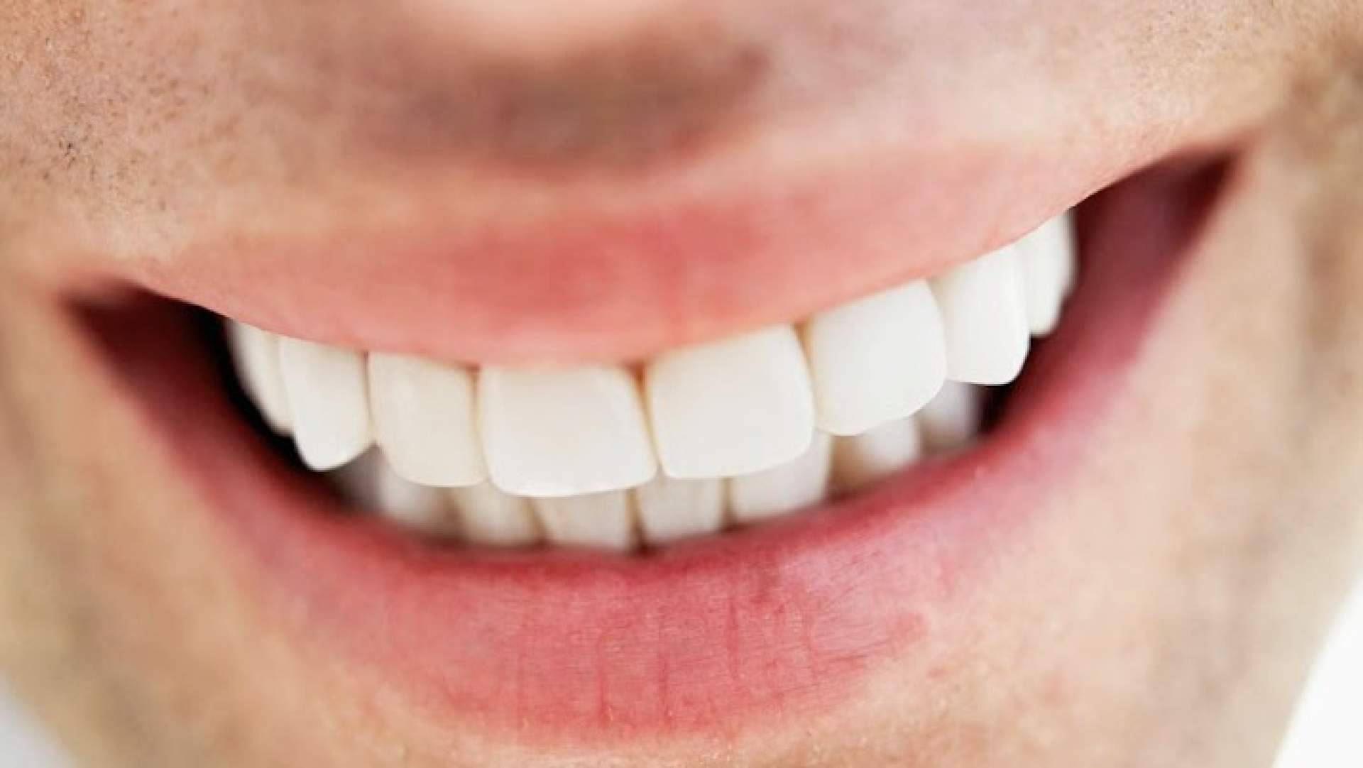 Carillas dentales y prótesis fija sin metal; la tendencia hacia una sonrisa más natural